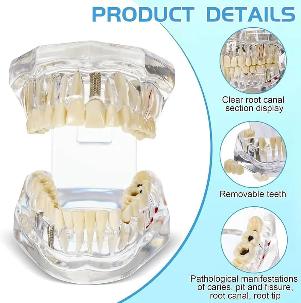 UIGJIOG Modello di Denti Trasparente Modello di Malattie Dentali Typodont Dentale Modello di Denti per Impianti con Denti Rimovibili Dimostrazione Standard del Dente per Dentisti - immagine 2