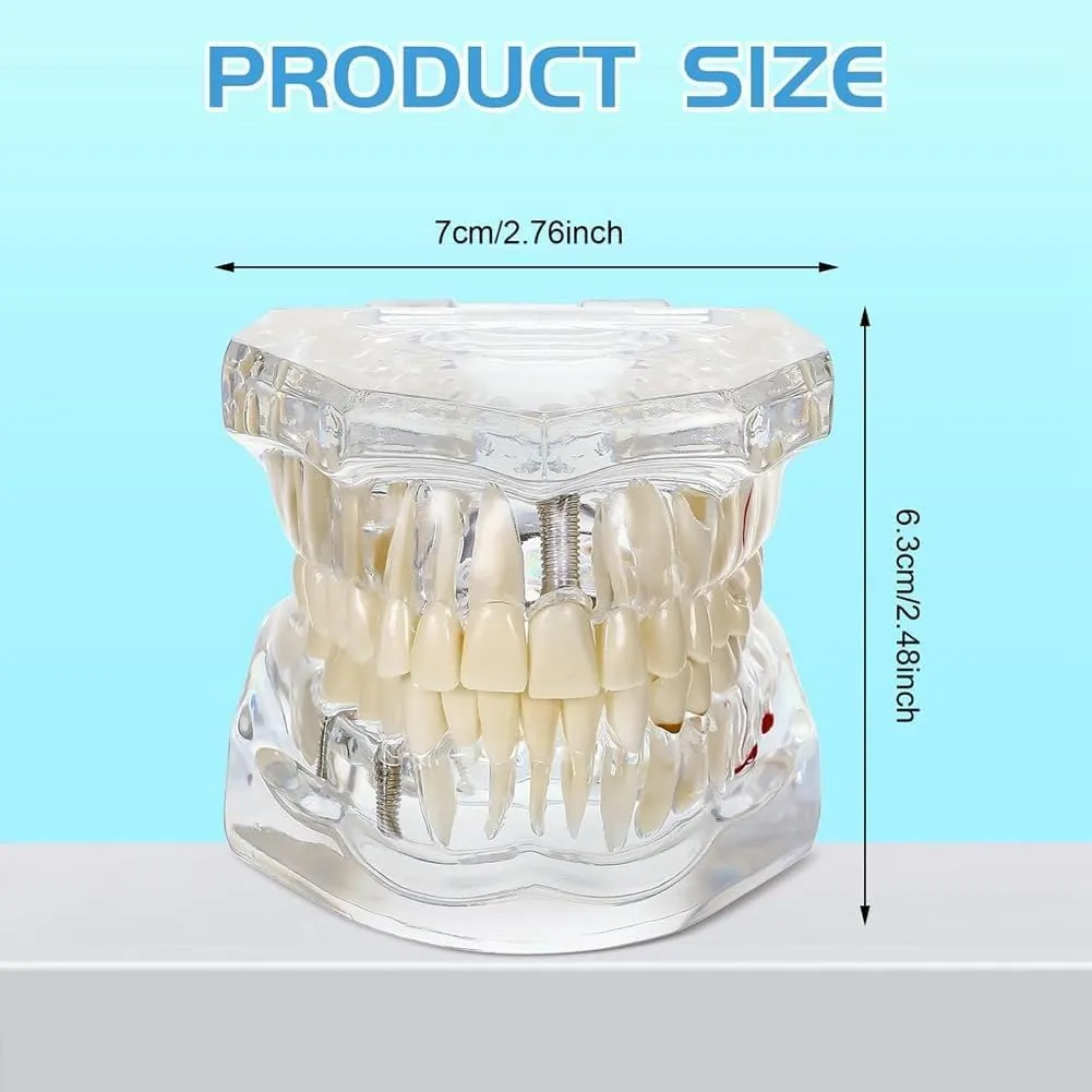 UIGJIOG Modello di Denti Trasparente Modello di Malattie Dentali Typodont Dentale Modello di Denti per Impianti con Denti Rimovibili Dimostrazione Standard del Dente per Dentisti - immagine 3