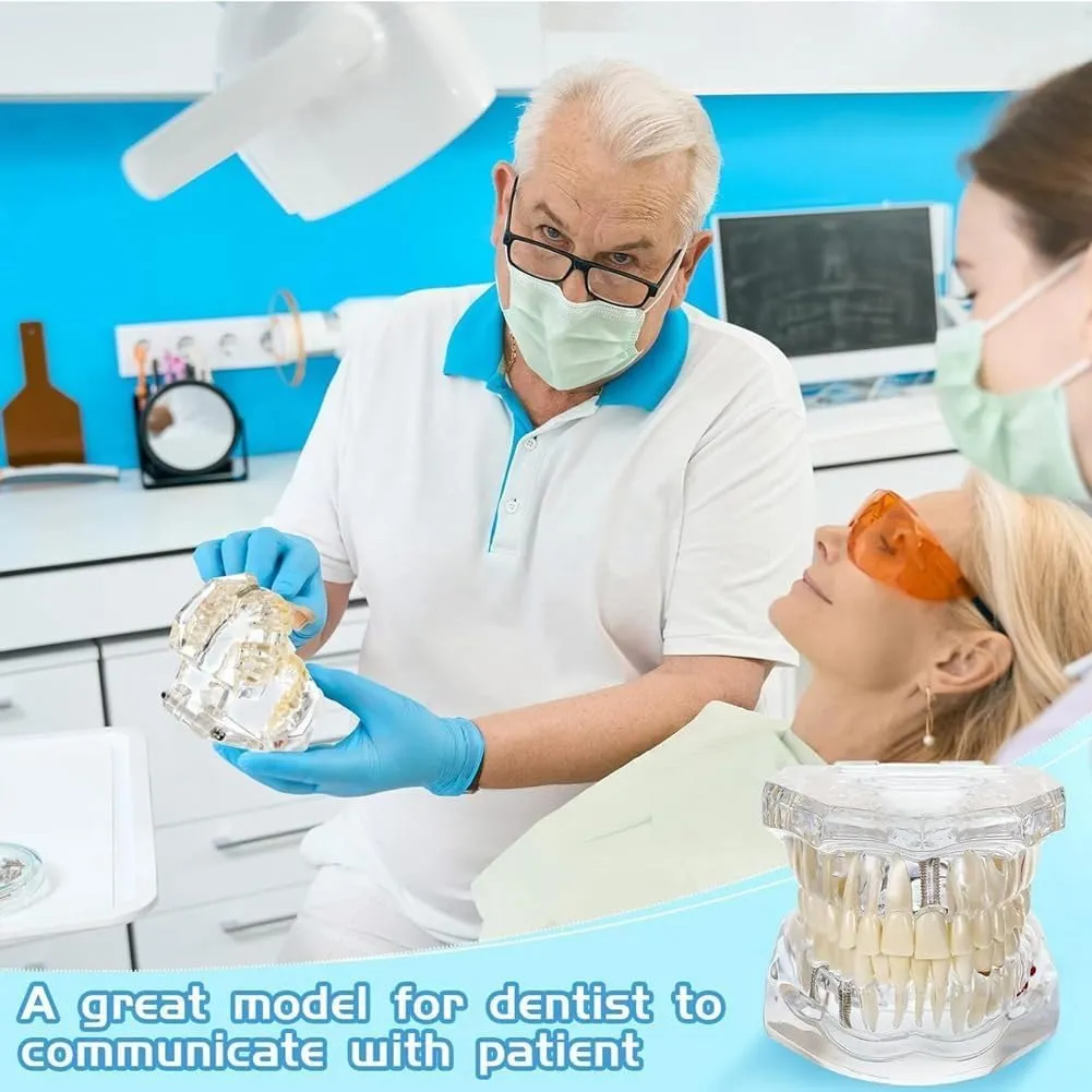 UIGJIOG Modello di Denti Trasparente Modello di Malattie Dentali Typodont Dentale Modello di Denti per Impianti con Denti Rimovibili Dimostrazione Standard del Dente per Dentisti - immagine 4