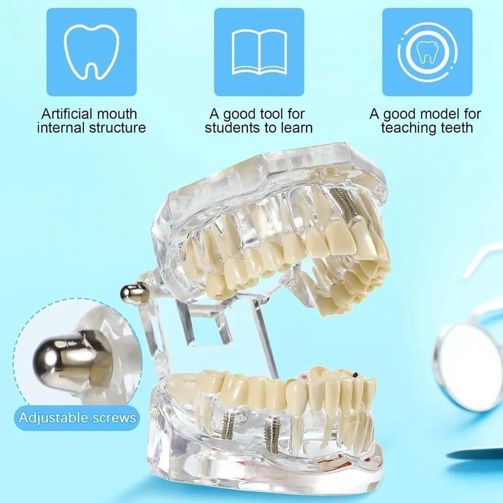 UIGJIOG Modello di Denti Trasparente Modello di Malattie Dentali Typodont Dentale Modello di Denti per Impianti con Denti Rimovibili Dimostrazione Standard del Dente per Dentisti - immagine 5
