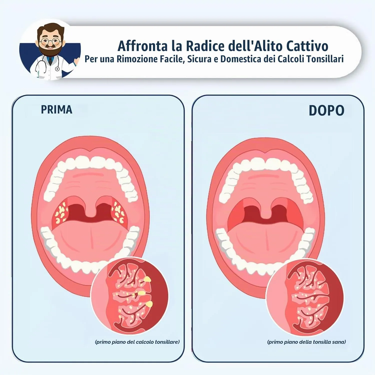 Kit for la Rimozione Dei Calcoli Tonsillari con Aspirapolvere Elettronico a 3 Livelli, Antialitosi, Irrigatore Orale, Kit for la Rimozione Dei Calcoli Tonsillari - immagine 4