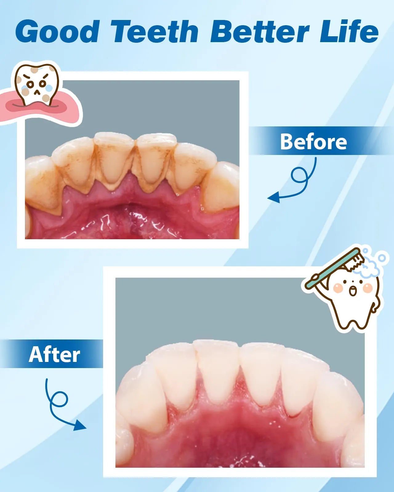 Lullu Kit Pulizia Denti Tartaro, Rimuovi Tartaro Denti per Persone e Cane - immagine 5