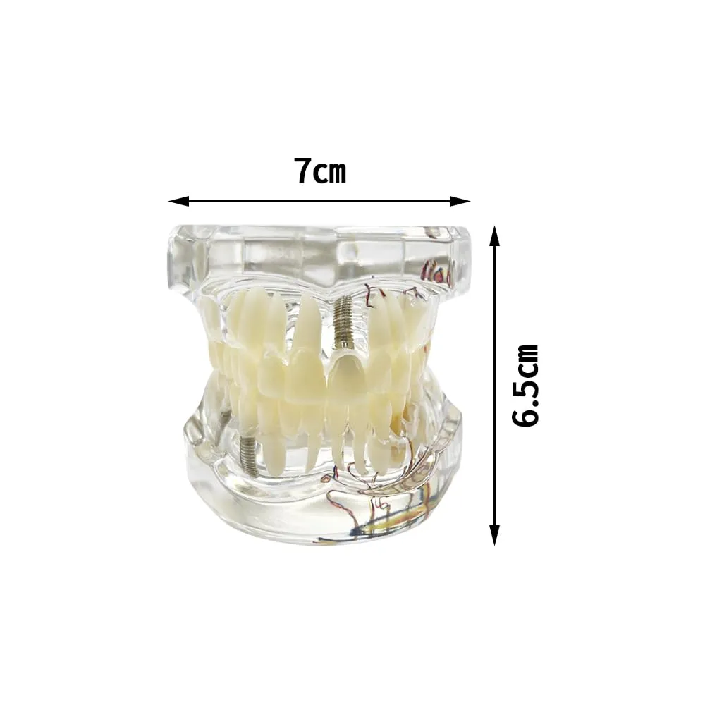 YOUYA DENTAL Modello dentale di riparazione neurale Modello dentale Malattia dell'impianto Modello dei denti Dentista Modello di insegnamento patologico standard dei denti rimovibili - immagine 3