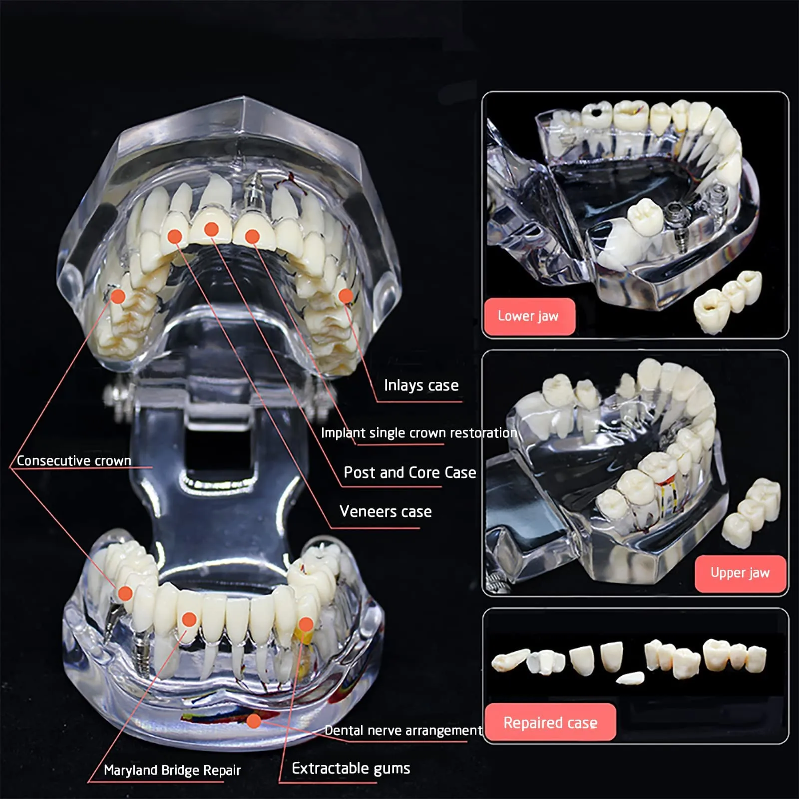 YOUYA DENTAL Modello dentale di riparazione neurale Modello dentale Malattia dell'impianto Modello dei denti Dentista Modello di insegnamento patologico standard dei denti rimovibili - immagine 4