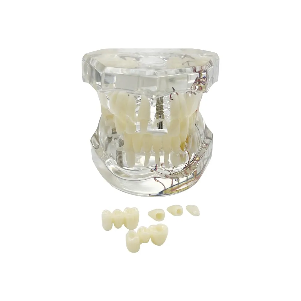 YOUYA DENTAL Modello dentale di riparazione neurale Modello dentale Malattia dell'impianto Modello dei denti Dentista Modello di insegnamento patologico standard dei denti rimovibili - immagine 5