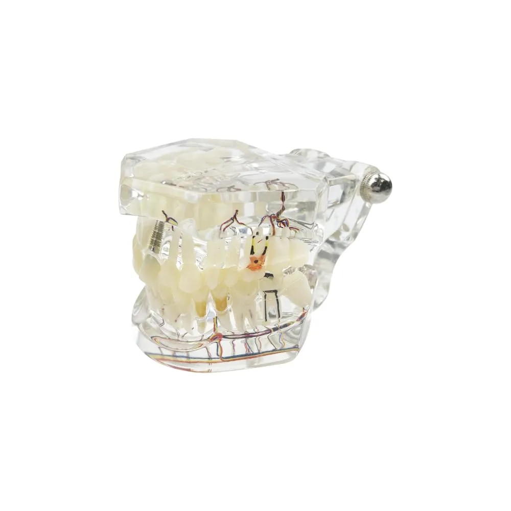 YOUYA DENTAL Modello dentale di riparazione neurale Modello dentale Malattia dell'impianto Modello dei denti Dentista Modello di insegnamento patologico standard dei denti rimovibili - immagine 6