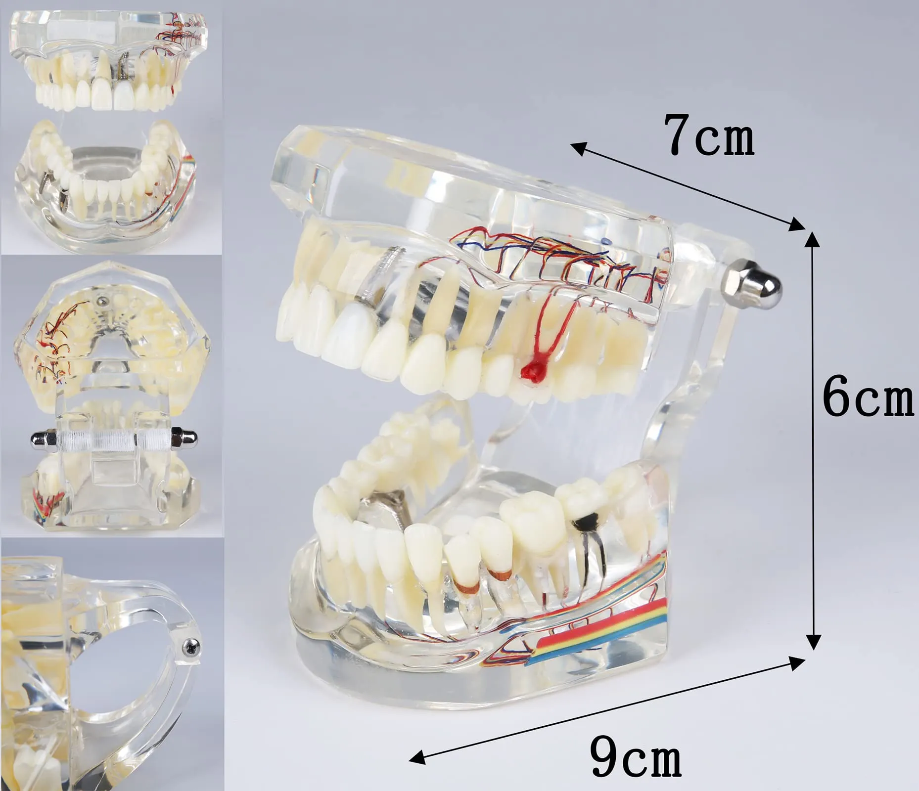 YOUYA DENTAL Modello dentale di riparazione neurale Modello dentale Malattia dell'impianto Modello dei denti Dentista Modello di insegnamento patologico standard dei denti rimovibili - immagine 7