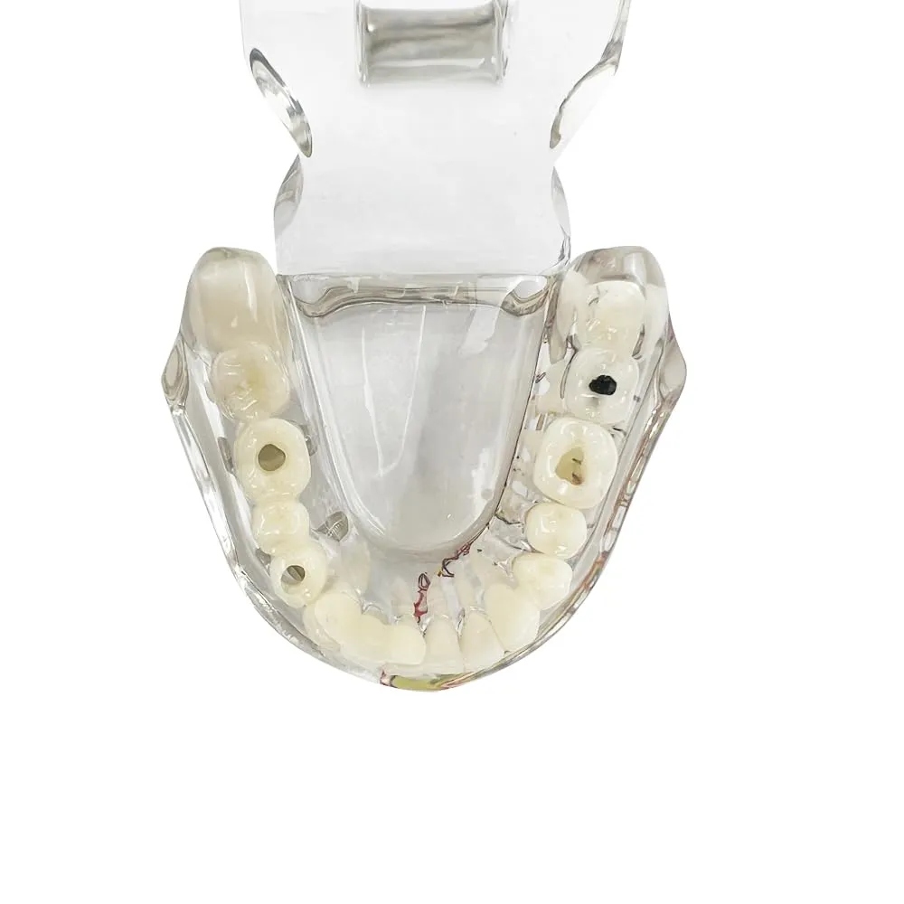 YOUYA DENTAL Modello dentale di riparazione neurale Modello dentale Malattia dell'impianto Modello dei denti Dentista Modello di insegnamento patologico standard dei denti rimovibili - immagine 8