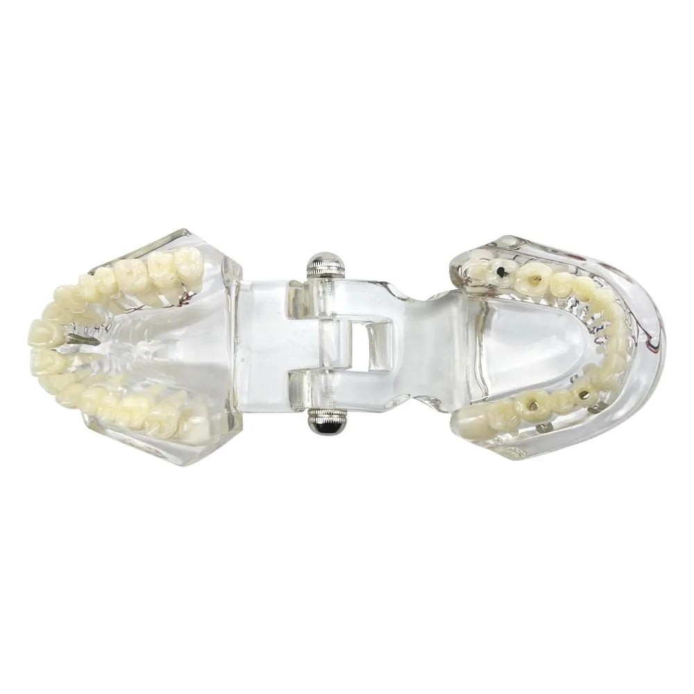 YOUYA DENTAL Modello dentale di riparazione neurale Modello dentale Malattia dell'impianto Modello dei denti Dentista Modello di insegnamento patologico standard dei denti rimovibili - immagine 9